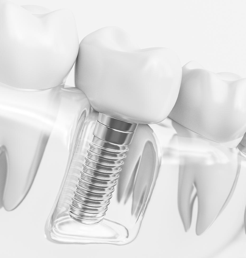 The image shows a close-up view of a dental implant fixture with a screw inside a tooth model, positioned above an actual human tooth with a visible filling, set against a white background.